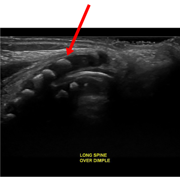 Hyperechoic - bone (neonatal spine.)